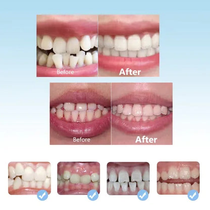 Gouttière Dentaire Transparente en Silicone – Correction du Sourire en 3 Étapes