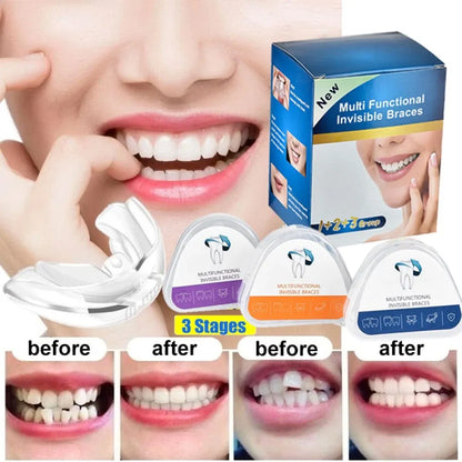 Gouttière Dentaire Transparente en Silicone – Correction du Sourire en 3 Étapes
